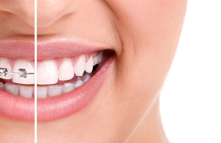 Braces