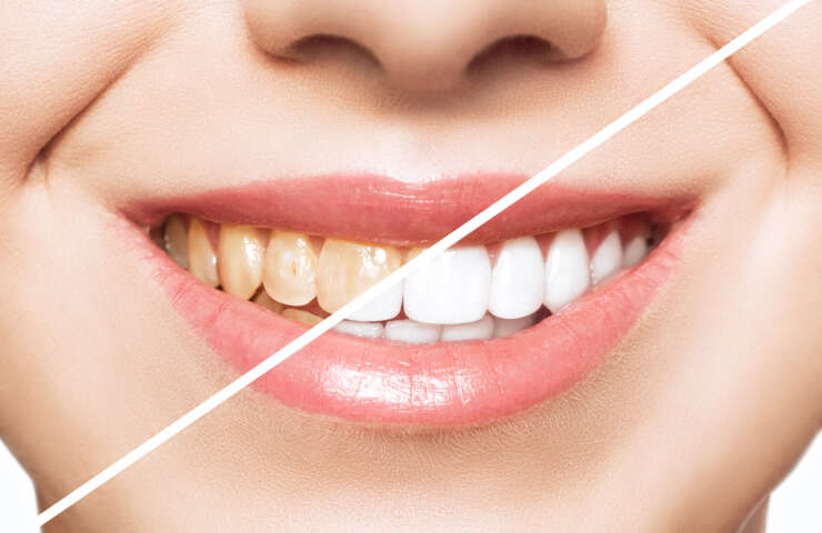 Whitening