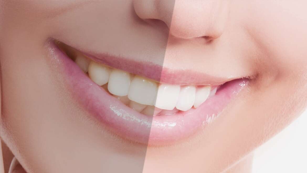 Teeth Whitening