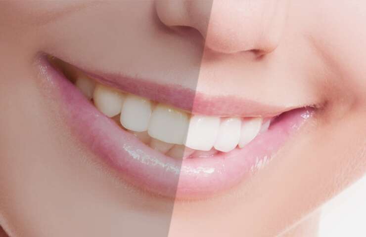 Teeth Whitening